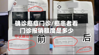 确诊癌症门诊/癌患者看门诊报销额度是多少
