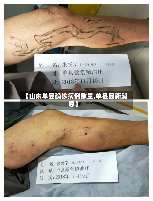 【山东单县确诊病例数量,单县最新消息】-第3张图片