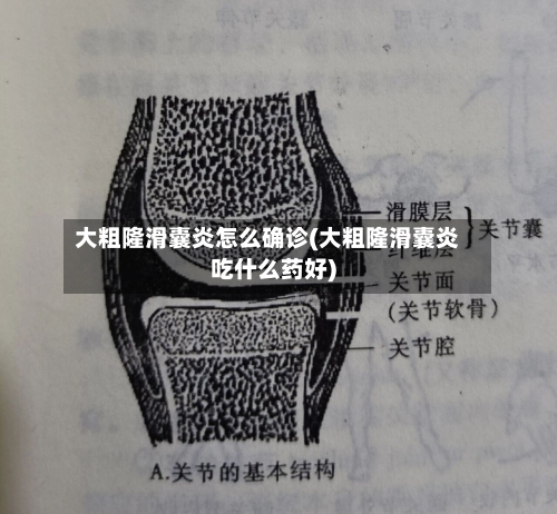 大粗隆滑囊炎怎么确诊(大粗隆滑囊炎吃什么药好)-第2张图片