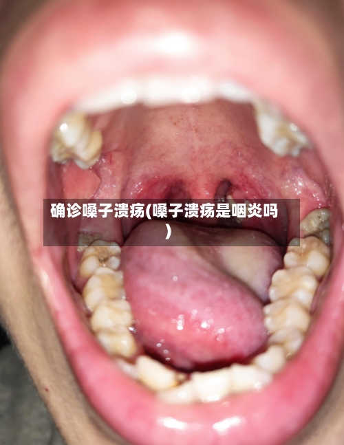 确诊嗓子溃疡(嗓子溃疡是咽炎吗)