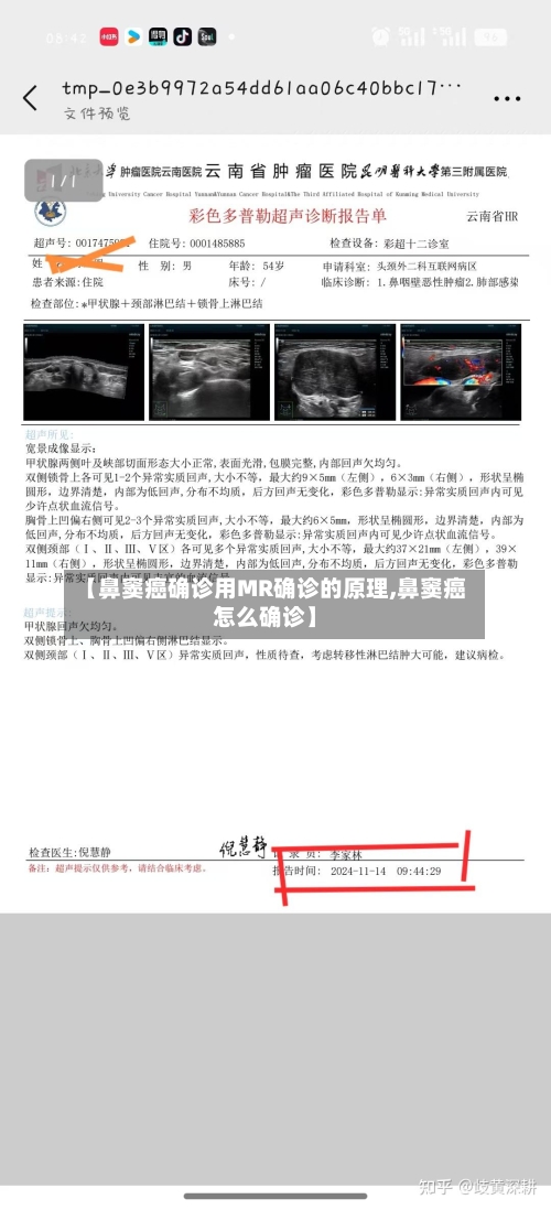 【鼻窦癌确诊用MR确诊的原理,鼻窦癌怎么确诊】-第2张图片