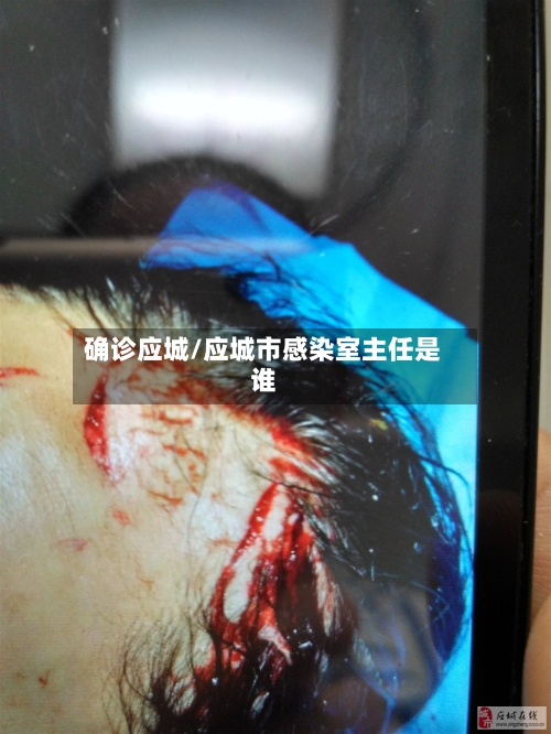确诊应城/应城市感染室主任是谁-第2张图片