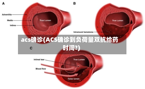 acs确诊(ACS确诊到负荷量双抗给药时间?)