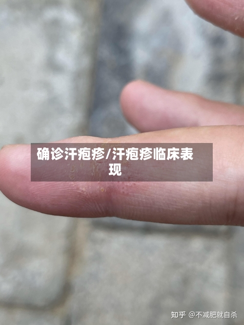 确诊汗疱疹/汗疱疹临床表现