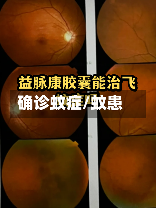 确诊蚊症/蚊患-第2张图片