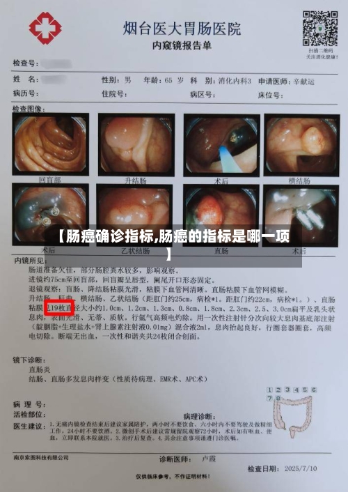 【肠癌确诊指标,肠癌的指标是哪一项】-第2张图片