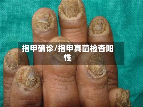 指甲确诊/指甲真菌检杳阳性