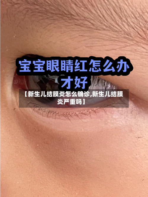 【新生儿结膜炎怎么确诊,新生儿结膜炎严重吗】-第2张图片