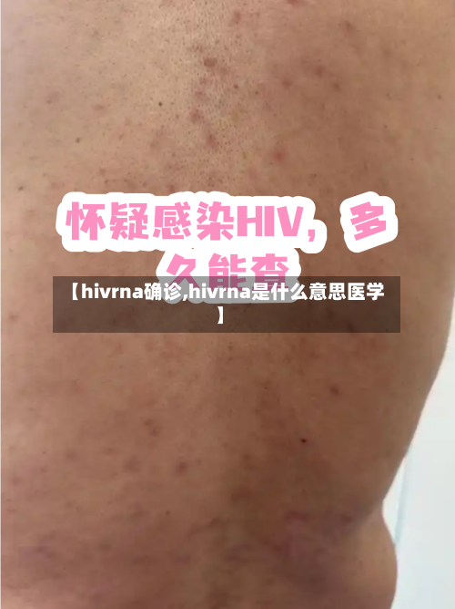 【hivrna确诊,hivrna是什么意思医学】-第3张图片