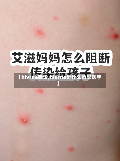 【hivrna确诊,hivrna是什么意思医学】-第2张图片