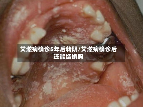 艾滋病确诊5年后转阴/艾滋病确诊后还能结婚吗-第2张图片