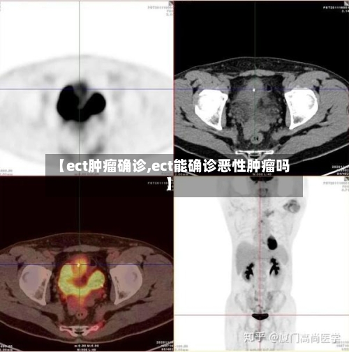 【ect肿瘤确诊,ect能确诊恶性肿瘤吗】