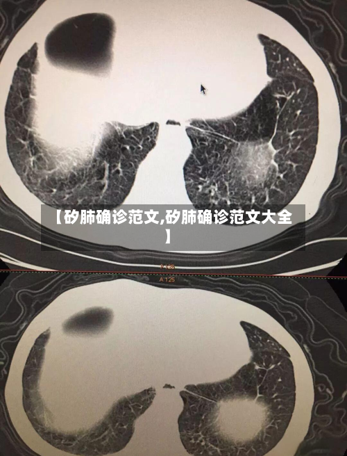 【矽肺确诊范文,矽肺确诊范文大全】