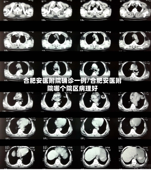 合肥安医附院确诊一例/合肥安医附院哪个院区病理好