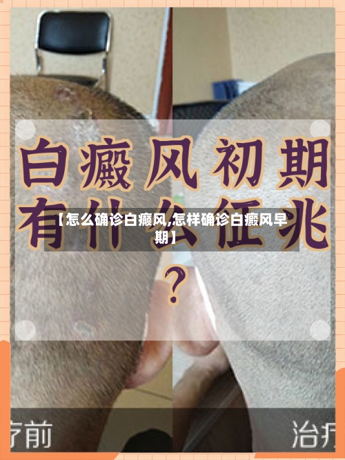 【怎么确诊白癫风,怎样确诊白癜风早期】-第2张图片