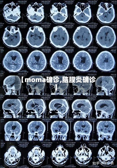 【moma确诊,脑膜炎确诊】-第2张图片