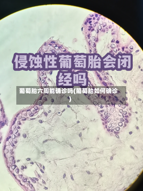 葡萄胎六周能确诊吗(葡萄胎如何确诊)