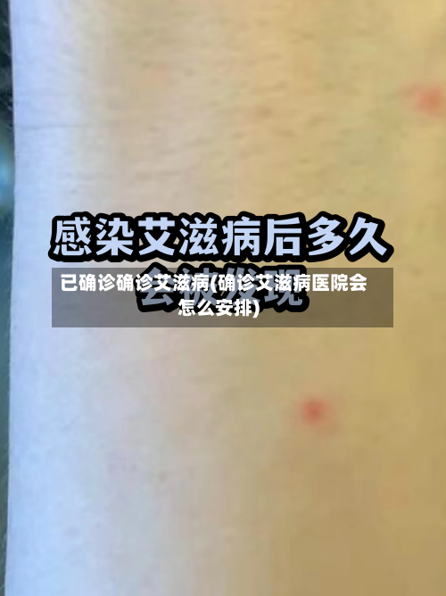 已确诊确诊艾滋病(确诊艾滋病医院会怎么安排)-第2张图片