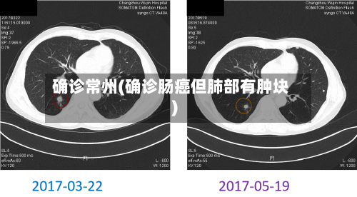 确诊常州(确诊肠癌但肺部有肿块)