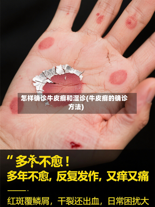 怎样确诊牛皮癣和湿诊(牛皮癣的确诊方法)