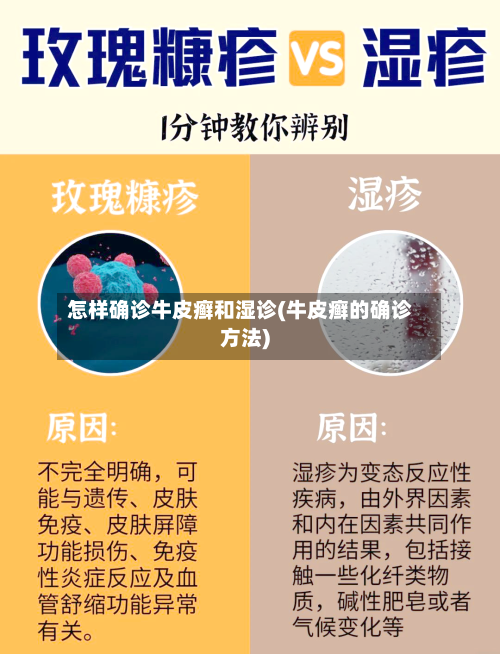 怎样确诊牛皮癣和湿诊(牛皮癣的确诊方法)-第2张图片