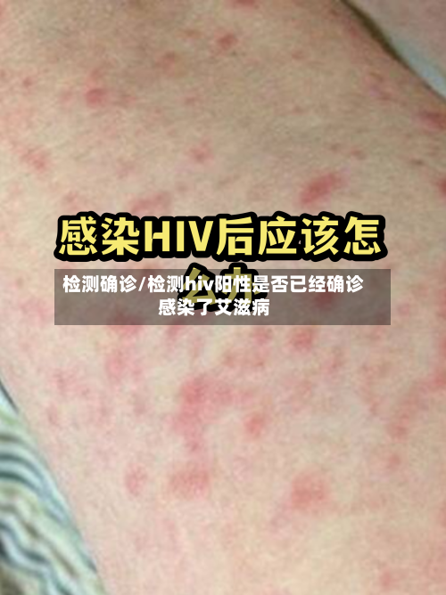 检测确诊/检测hiv阳性是否已经确诊感染了艾滋病-第3张图片