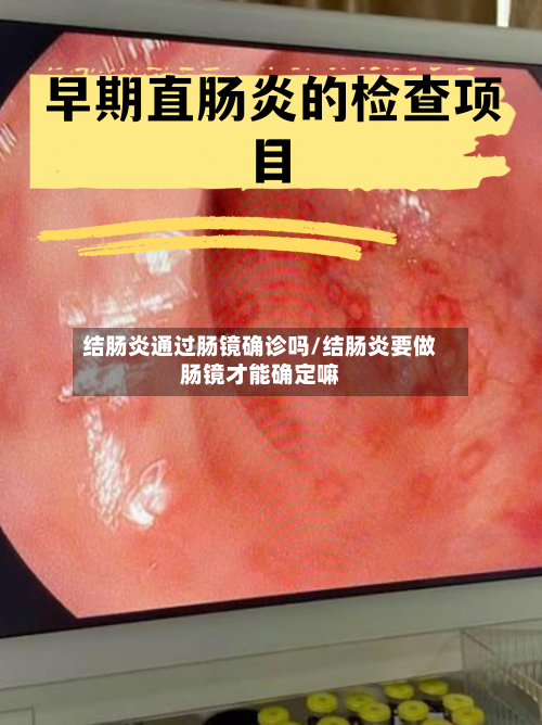 结肠炎通过肠镜确诊吗/结肠炎要做肠镜才能确定嘛-第2张图片