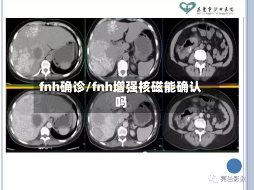 fnh确诊/fnh增强核磁能确认吗