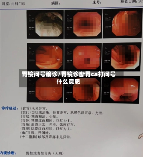 胃镜问号确诊/胃镜诊断胃ca打问号什么意思-第3张图片