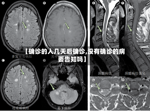 【确诊的人几天后确诊,没有确诊的病要告知吗】-第3张图片