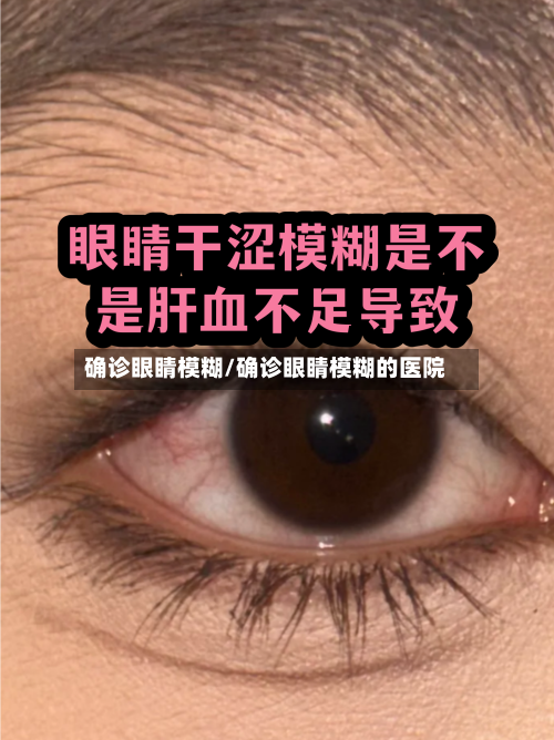 确诊眼睛模糊/确诊眼睛模糊的医院-第2张图片