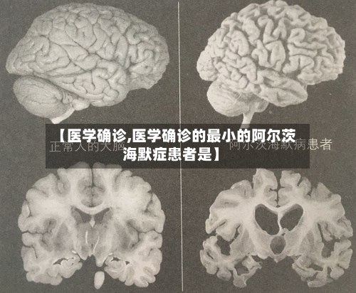 【医学确诊,医学确诊的最小的阿尔茨海默症患者是】