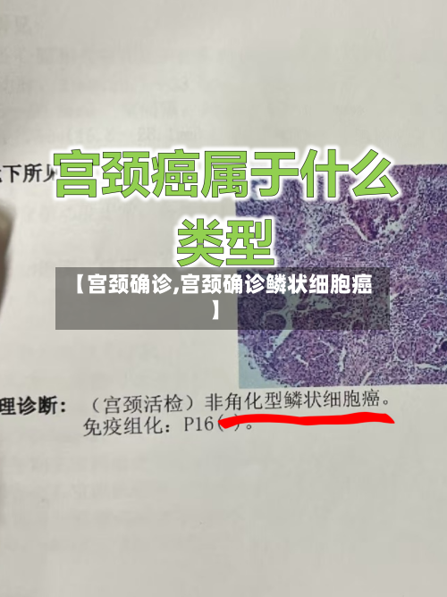 【宫颈确诊,宫颈确诊鳞状细胞癌】