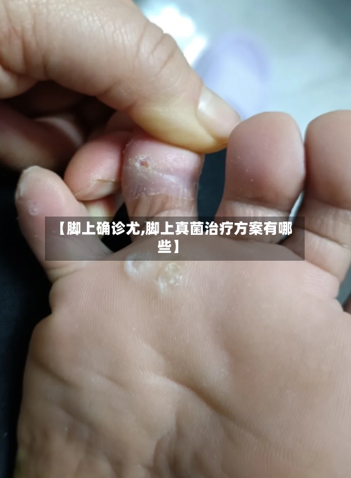 【脚上确诊尤,脚上真菌治疗方案有哪些】