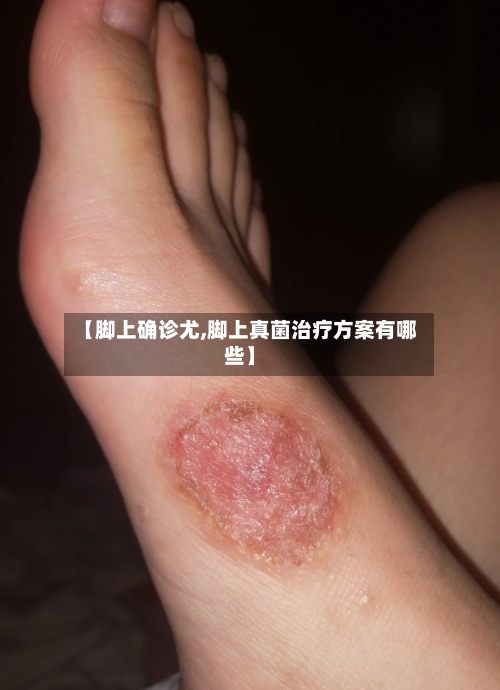 【脚上确诊尤,脚上真菌治疗方案有哪些】-第3张图片