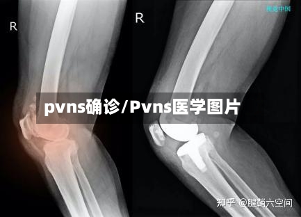 pvns确诊/Pvns医学图片
