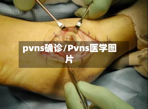 pvns确诊/Pvns医学图片-第2张图片