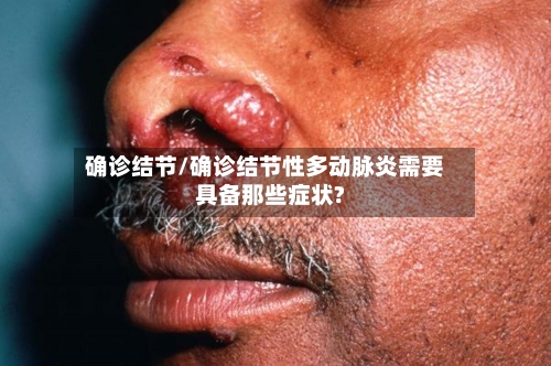 确诊结节/确诊结节性多动脉炎需要具备那些症状?