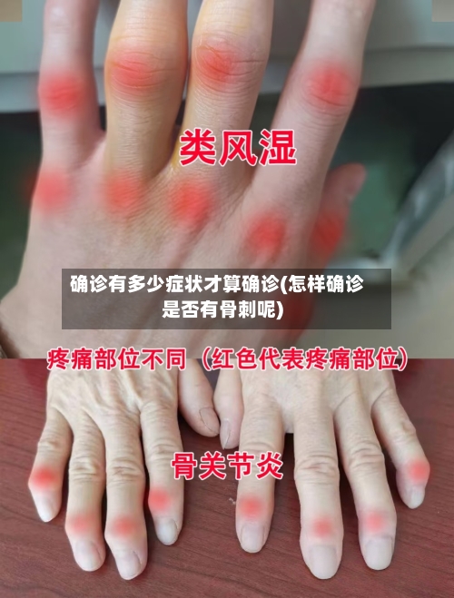 确诊有多少症状才算确诊(怎样确诊是否有骨刺呢)-第2张图片