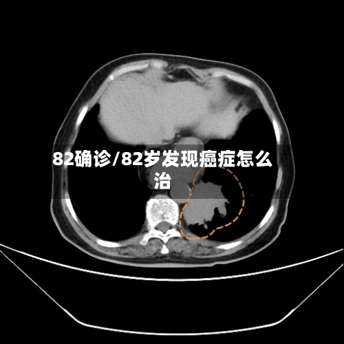 82确诊/82岁发现癌症怎么治