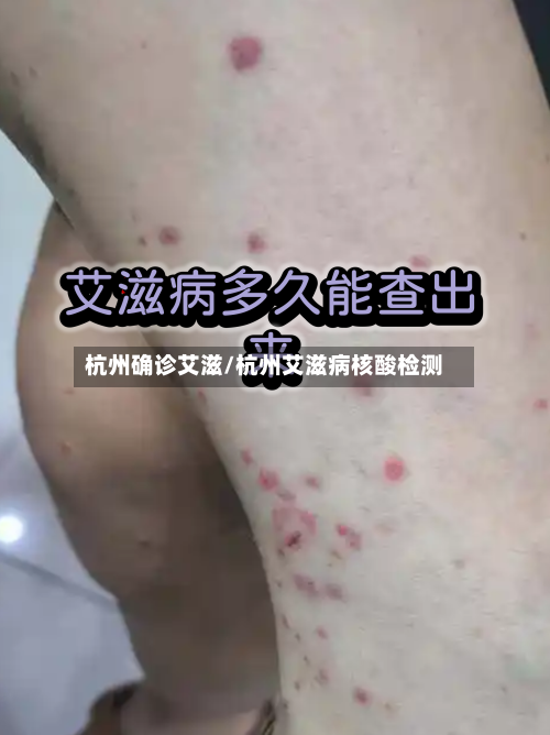 杭州确诊艾滋/杭州艾滋病核酸检测