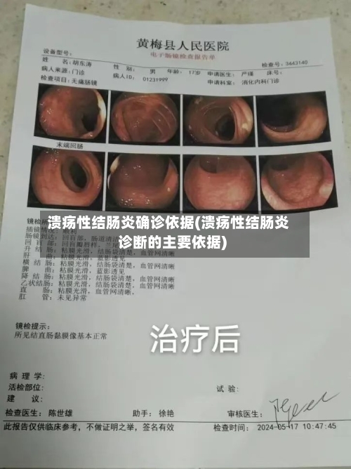 溃疡性结肠炎确诊依据(溃疡性结肠炎诊断的主要依据)