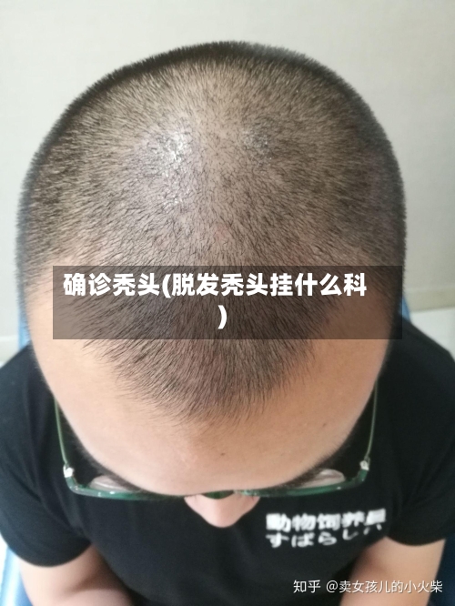 确诊秃头(脱发秃头挂什么科)-第2张图片