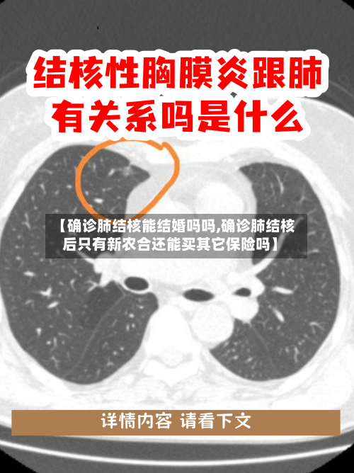 【确诊肺结核能结婚吗吗,确诊肺结核后只有新农合还能买其它保险吗】