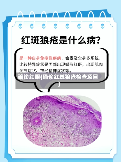 确诊红眼(确诊红斑狼疮检查项目)-第2张图片