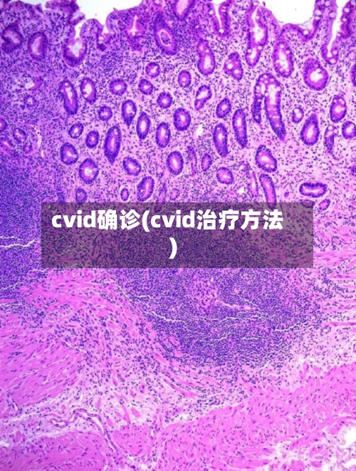 cvid确诊(cvid治疗方法)-第3张图片