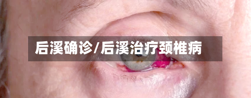 后溪确诊/后溪治疗颈椎病-第3张图片