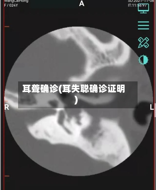 耳聋确诊(耳失聪确诊证明)