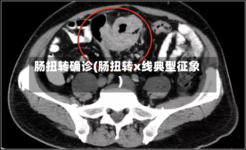 肠扭转确诊(肠扭转x线典型征象)