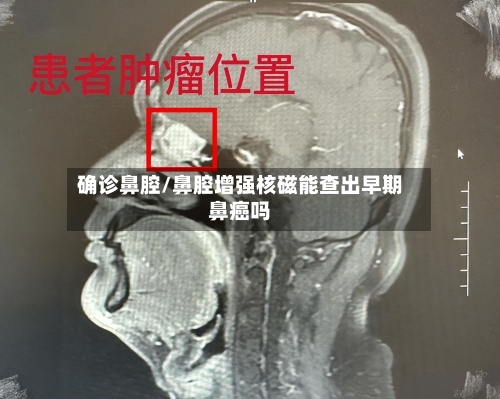确诊鼻腔/鼻腔增强核磁能查出早期鼻癌吗